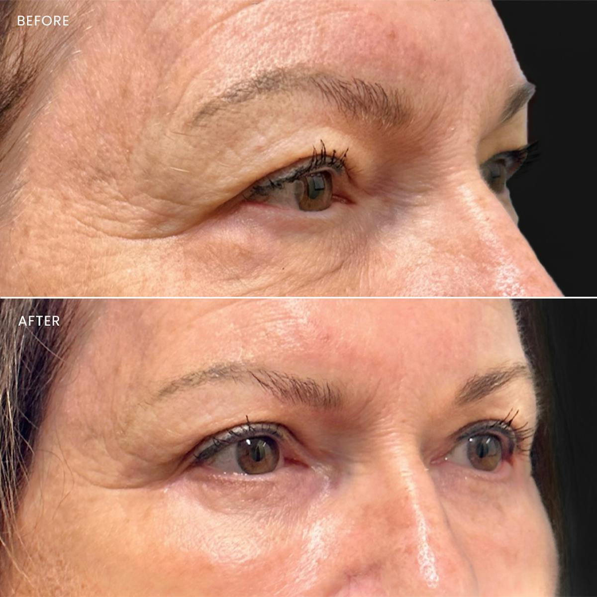 Eyelid Surgery (Blepharoplasty) Before & After Gallery - Patient 151193 - Image 1