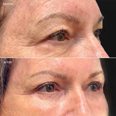 Eyelid Surgery (Blepharoplasty) Before & After Gallery - Patient 151193 - Image 1