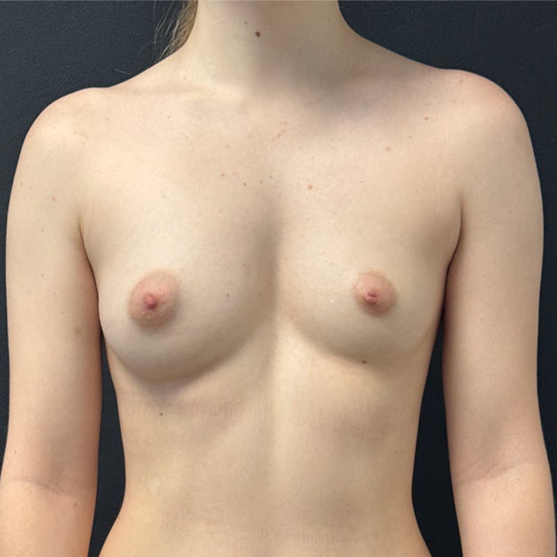 Breast Augmentation Before & After Gallery - Patient 252953 - Image 4