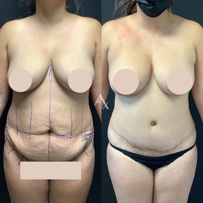 Tummy Tuck (Abdominoplasty) Before & After Gallery - Patient 163753 - Image 1