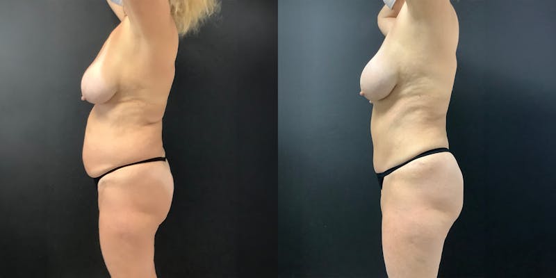 Tummy Tuck (Abdominoplasty) Before & After Gallery - Patient 136034 - Image 2