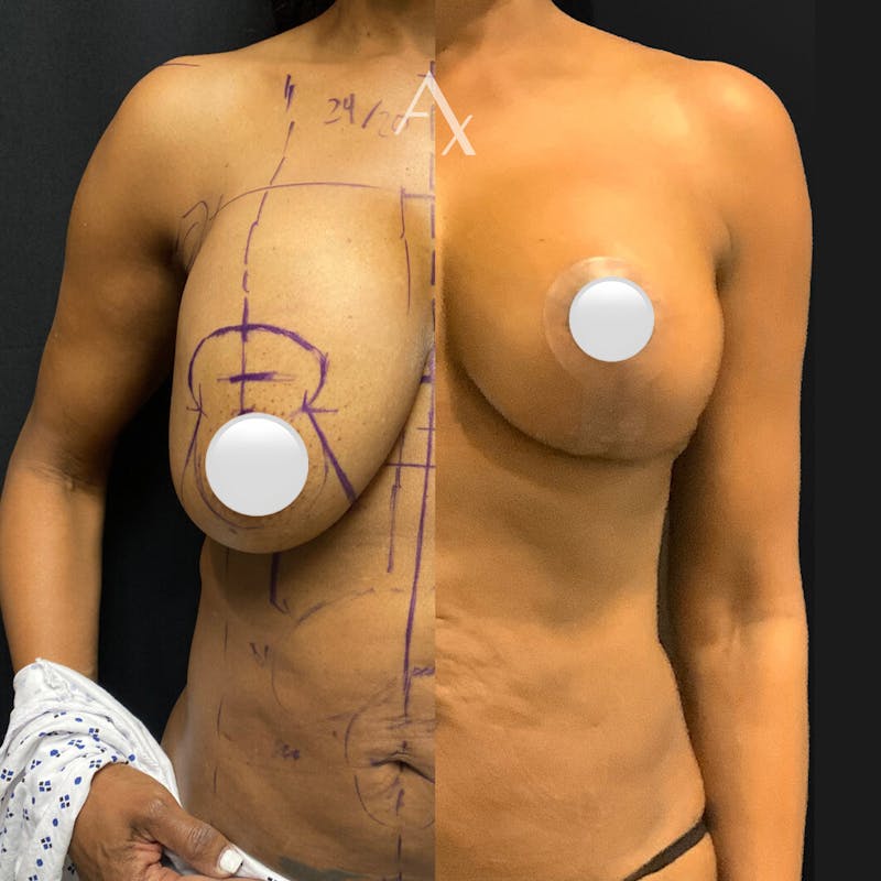 Breast Lift Before & After Gallery - Patient 164755 - Image 1