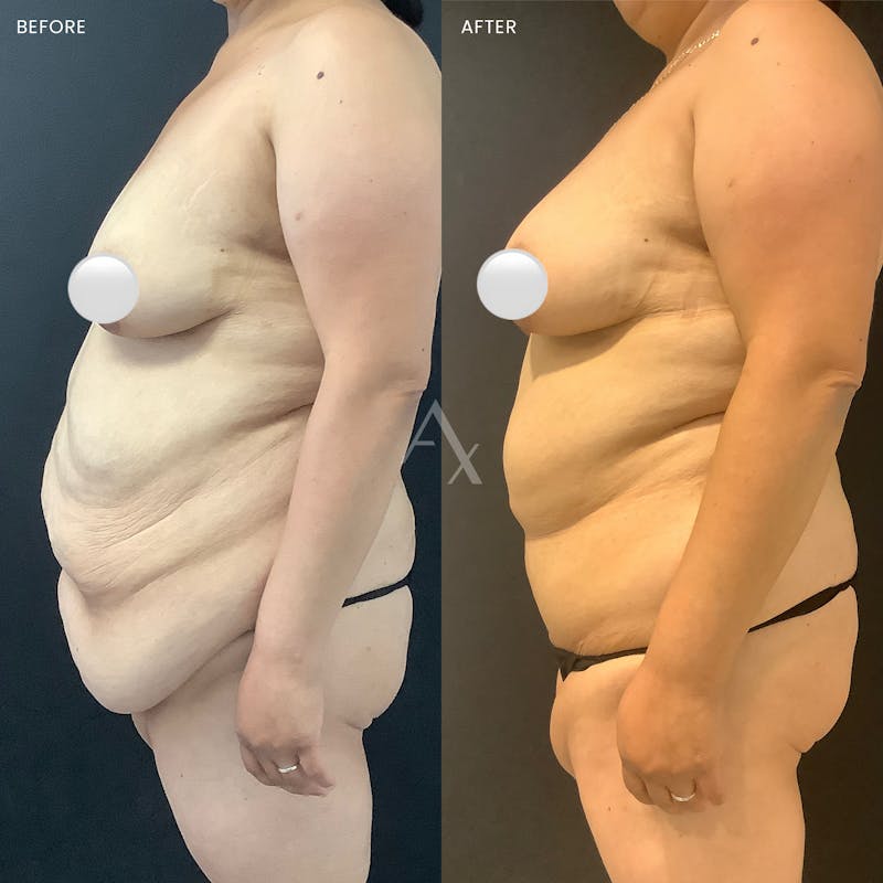 Tummy Tuck (Abdominoplasty) Before & After Gallery - Patient 303727 - Image 2
