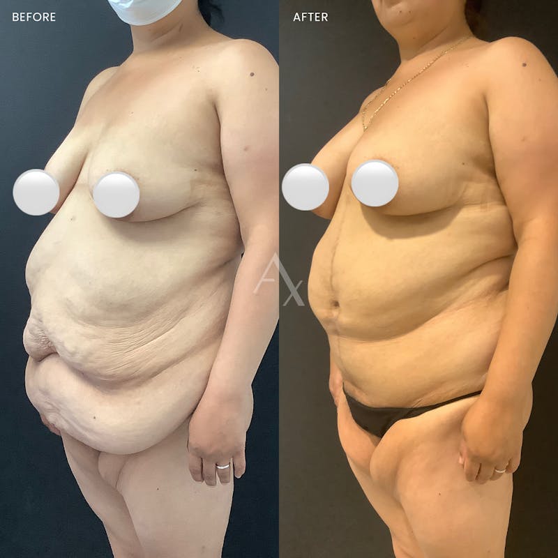 Tummy Tuck (Abdominoplasty) Before & After Gallery - Patient 303727 - Image 3