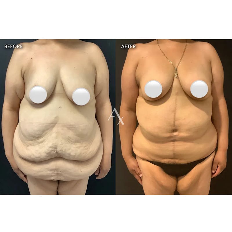 Tummy Tuck (Abdominoplasty) Before & After Gallery - Patient 303727 - Image 1