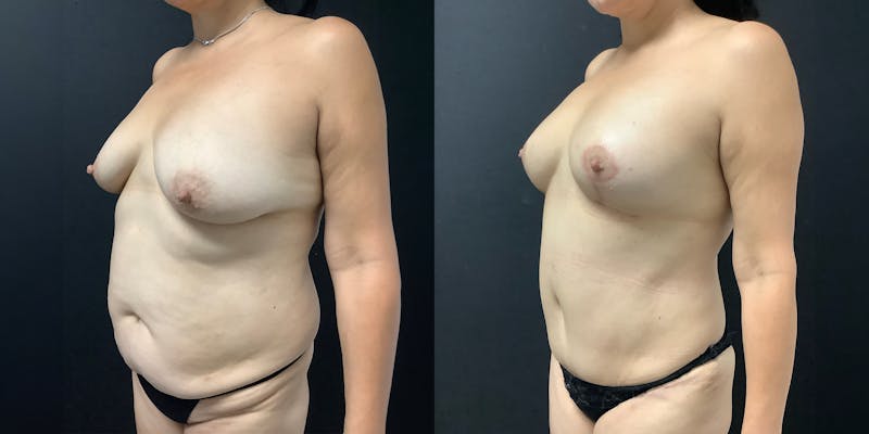 Tummy Tuck (Abdominoplasty) Before & After Gallery - Patient 325899 - Image 2