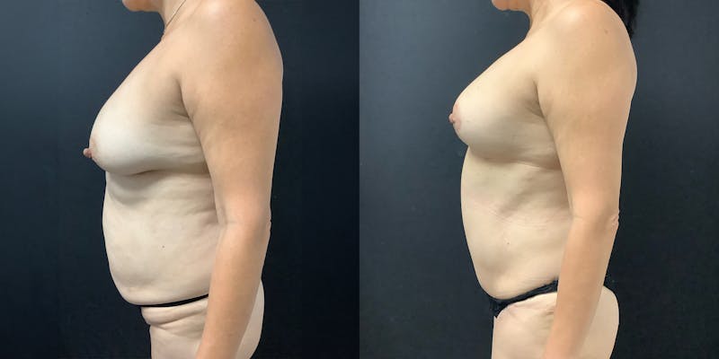 Tummy Tuck (Abdominoplasty) Before & After Gallery - Patient 325899 - Image 1