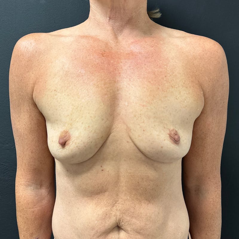 Preservé™ Breast Enhancement Before & After Gallery - Patient 292038 - Image 1