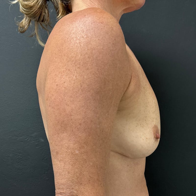 Preservé™ Breast Enhancement Before & After Gallery - Patient 292038 - Image 5