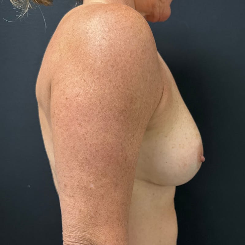 Preservé™ Breast Enhancement Before & After Gallery - Patient 292038 - Image 6