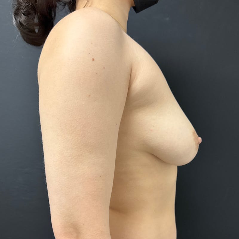 Preservé™ Breast Enhancement Before & After Gallery - Patient 131217 - Image 5