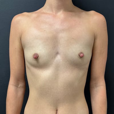 Preservé™ Breast Enhancement Before & After Gallery - Patient 326851 - Image 1