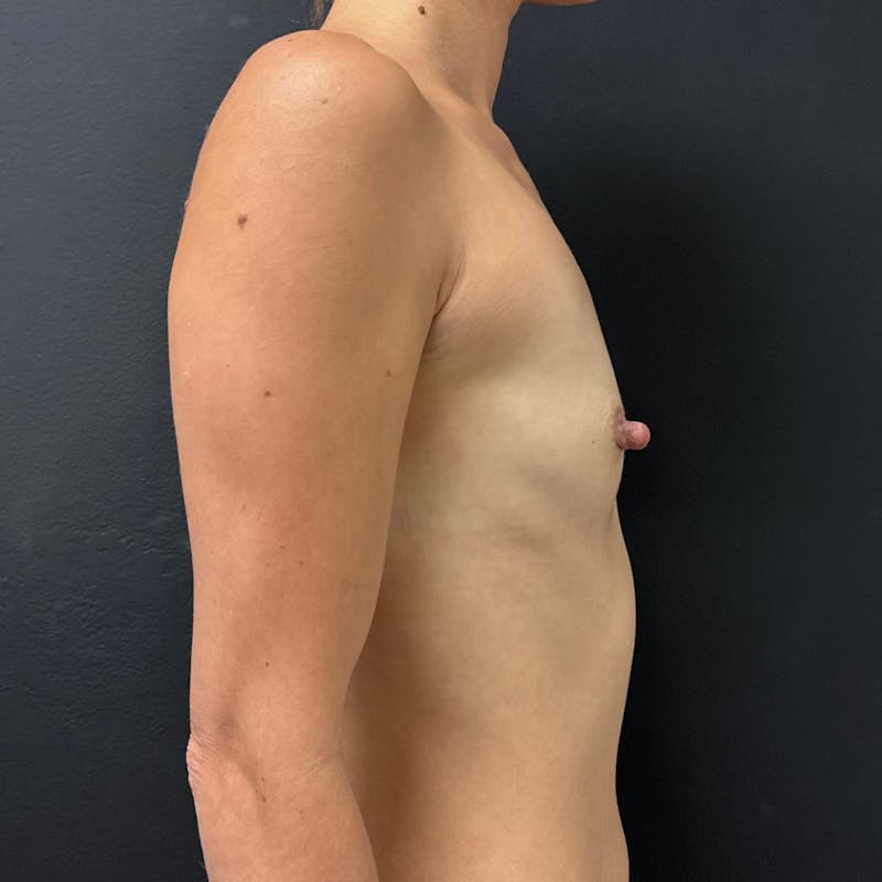 Preservé™ Breast Enhancement Before & After Gallery - Patient 326851 - Image 5