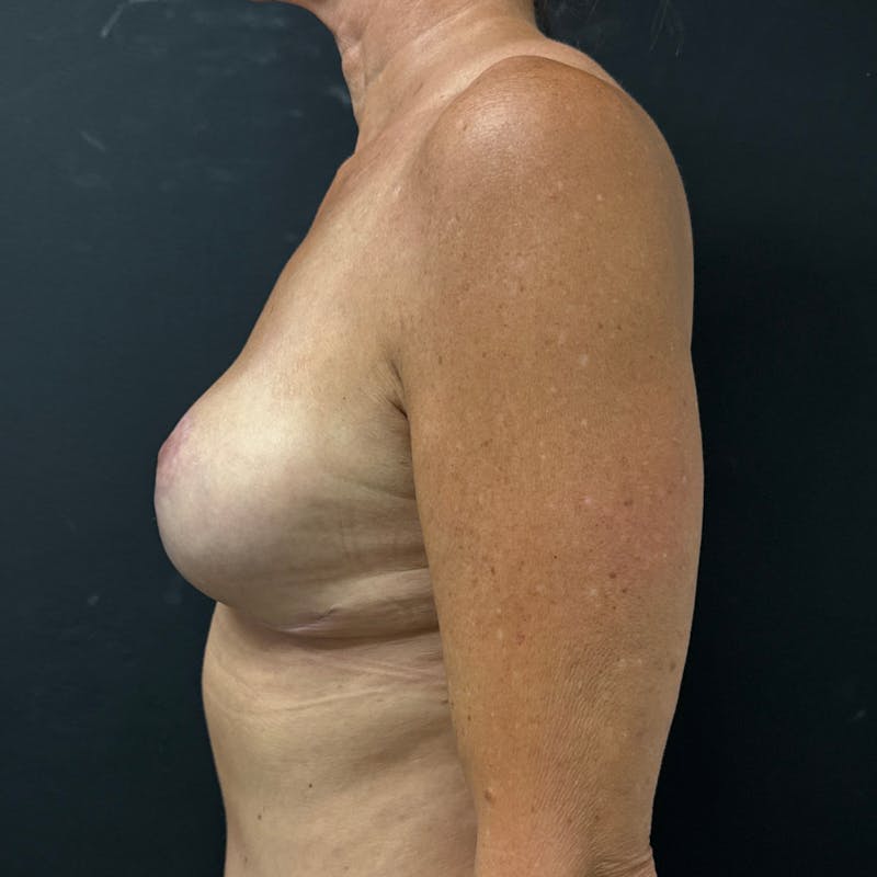 Breast Lift Before & After Gallery - Patient 329837 - Image 6