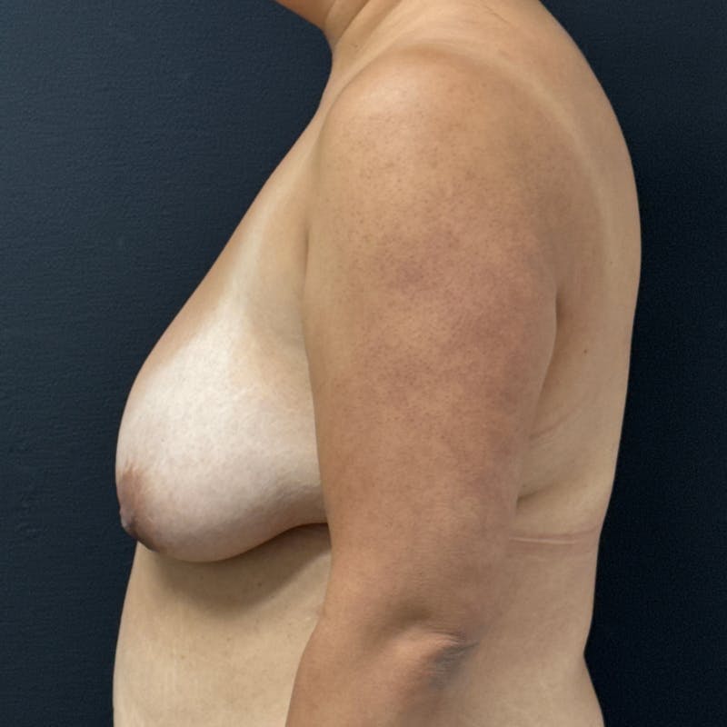 Breast Lift Before & After Gallery - Patient 140235 - Image 4