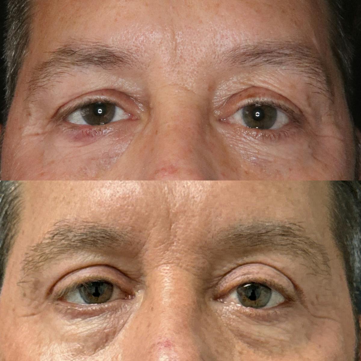 Eyelid Surgery (Blepharoplasty) Before & After Gallery - Patient 460608 - Image 1