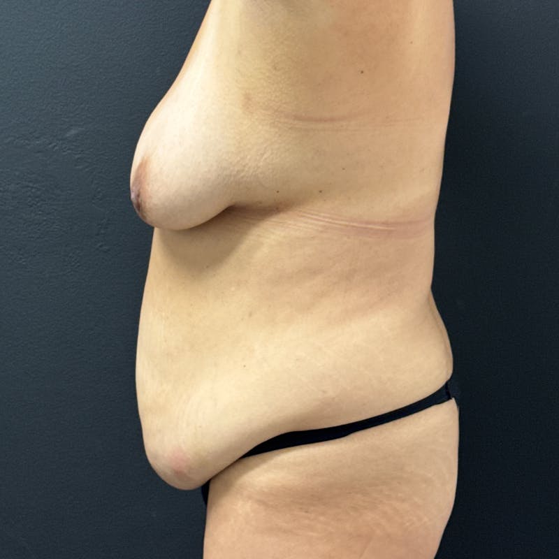 Tummy Tuck (Abdominoplasty) Before & After Gallery - Patient 257995 - Image 5