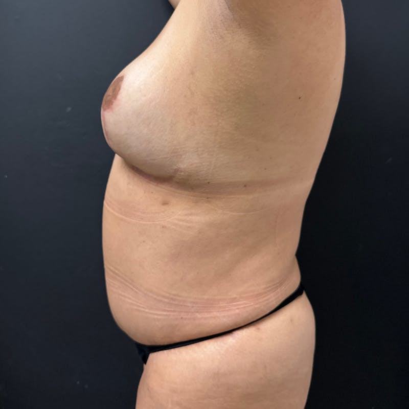 Tummy Tuck (Abdominoplasty) Before & After Gallery - Patient 257995 - Image 6