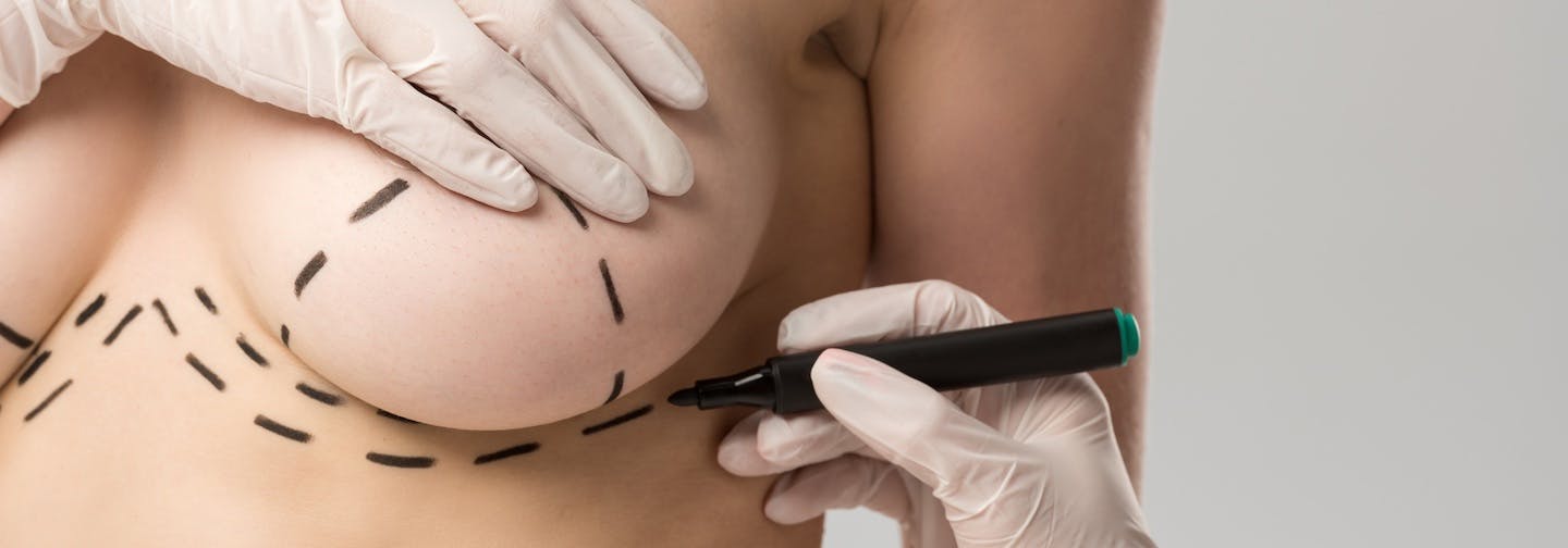 markings on a woman's breast done in preparation for aesthetic surgery, illustrative