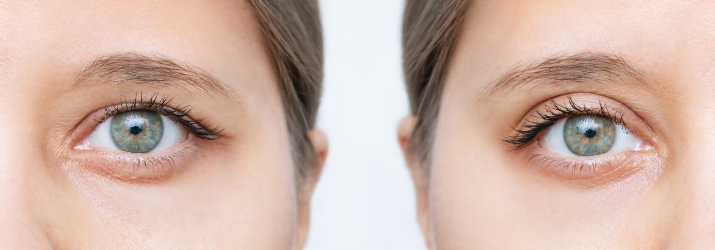 illustrative image showing the before and after of an eyelid rejuvenating aesthetic procedure
