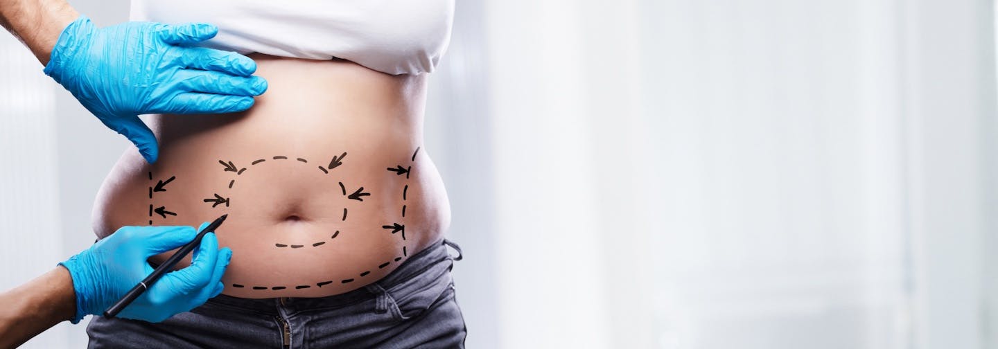 Abdomen being marked up by gloved hands in preparation for surgery