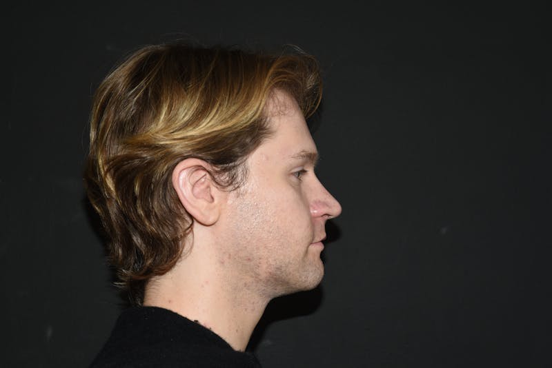 Fat Transfer Before & After Gallery - Patient 183969 - Image 5