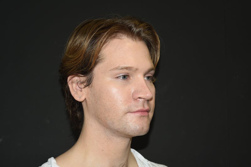 Fat Transfer Before & After Gallery - Patient 183969 - Image 4