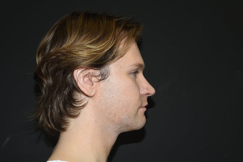 Fat Transfer Before & After Gallery - Patient 183969 - Image 6