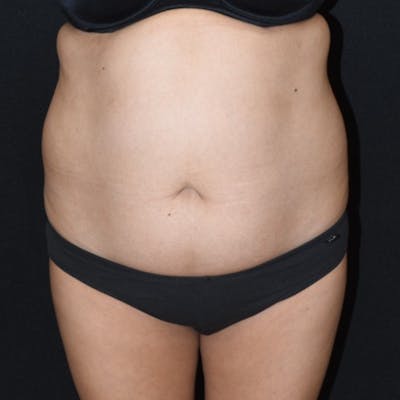 Tummy Tuck (Abdominoplasty) Before & After Gallery - Patient 369624 - Image 1