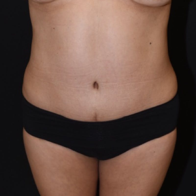 Tummy Tuck (Abdominoplasty) Before & After Gallery - Patient 369624 - Image 2