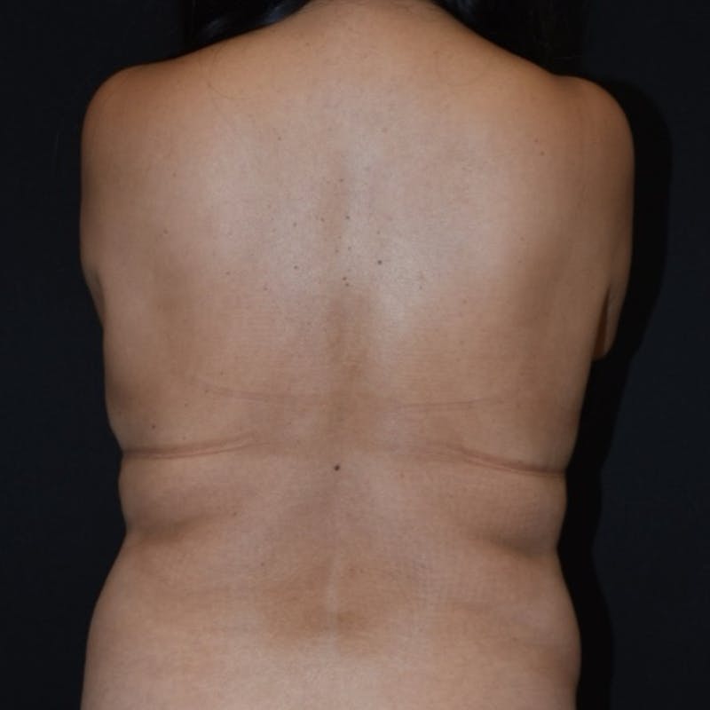 Tummy Tuck (Abdominoplasty) Before & After Gallery - Patient 369624 - Image 3