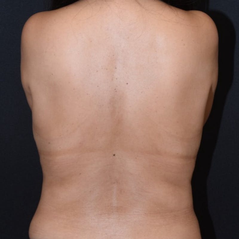 Tummy Tuck (Abdominoplasty) Before & After Gallery - Patient 369624 - Image 4