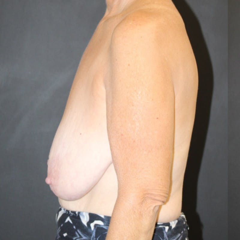 Breast Lift Before & After Gallery - Patient 197961 - Image 5