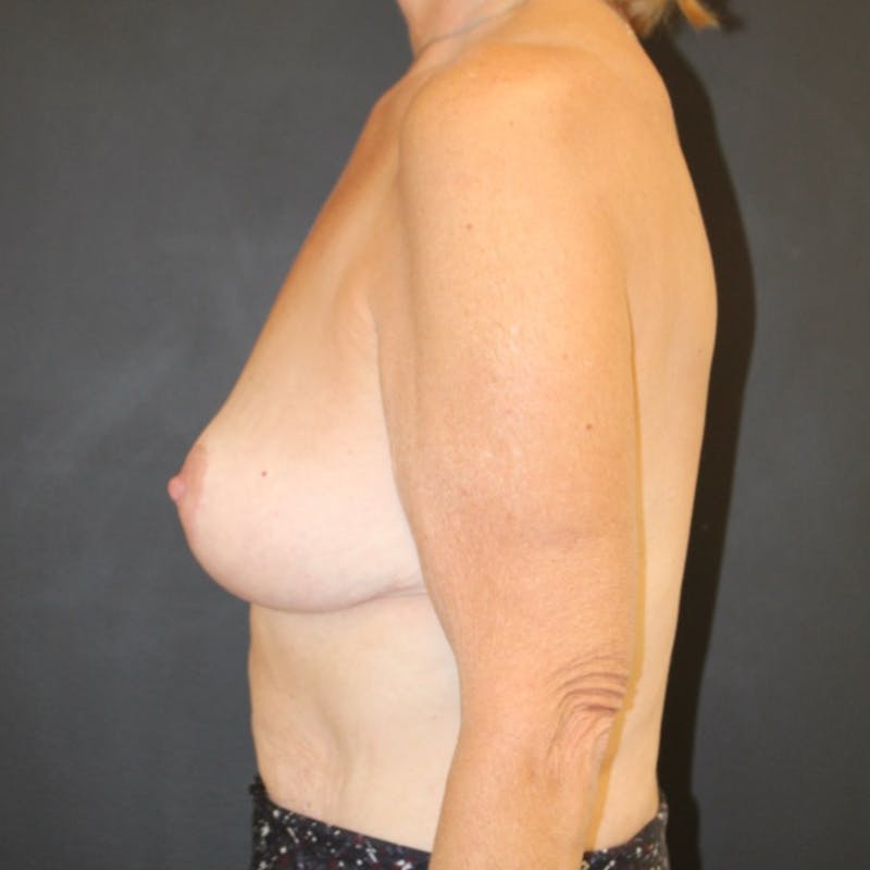 Breast Lift Before & After Gallery - Patient 197961 - Image 6