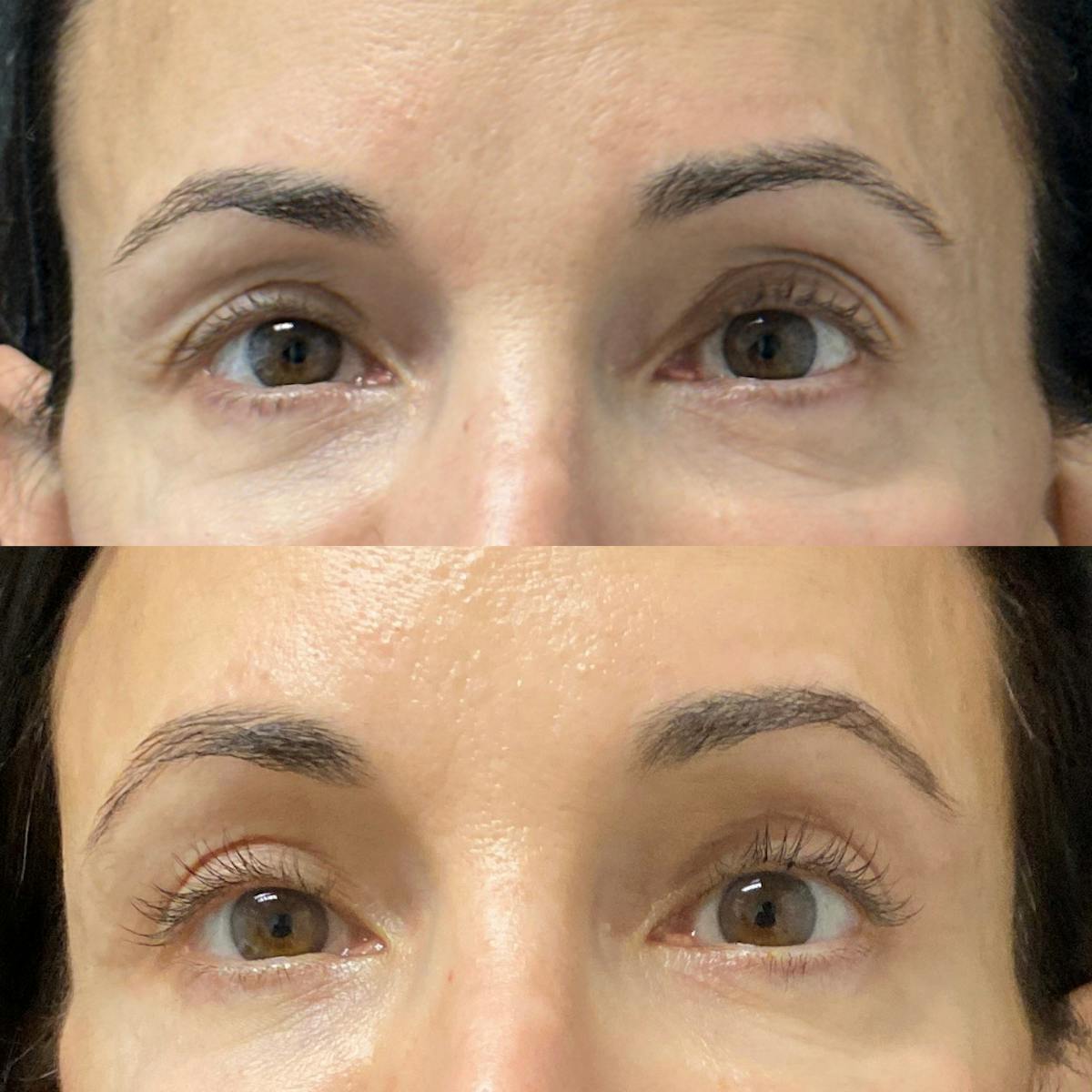 Eyelid Surgery (Blepharoplasty) Before & After Gallery - Patient 105736 - Image 2
