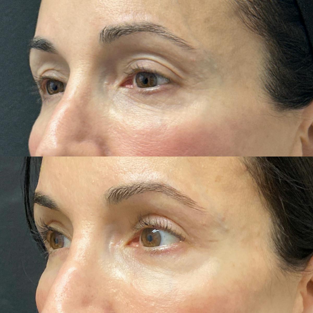 Eyelid Surgery (Blepharoplasty) Before & After Gallery - Patient 105736 - Image 1