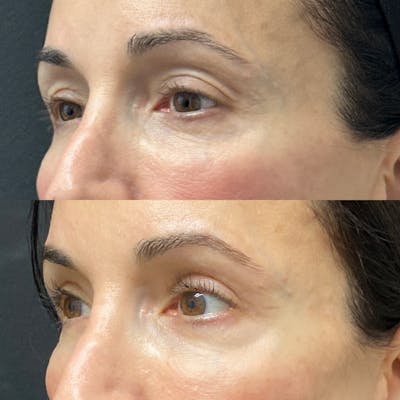 Eyelid Surgery (Blepharoplasty) Before & After Gallery - Patient 105736 - Image 1