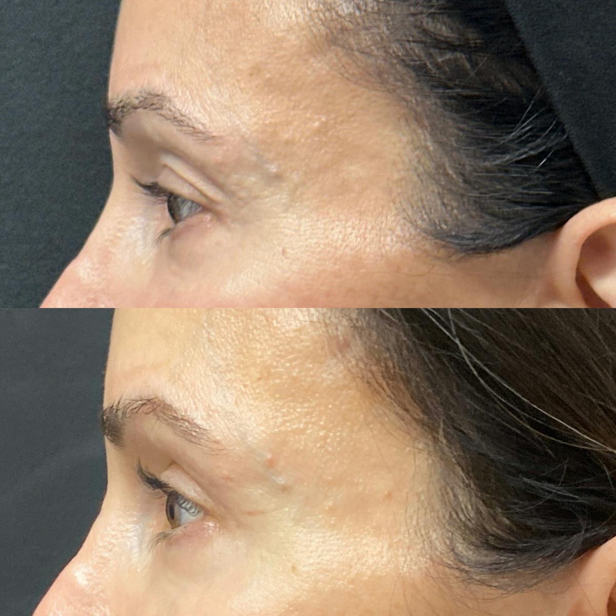 Eyelid Surgery (Blepharoplasty) Before & After Gallery - Patient 105736 - Image 3