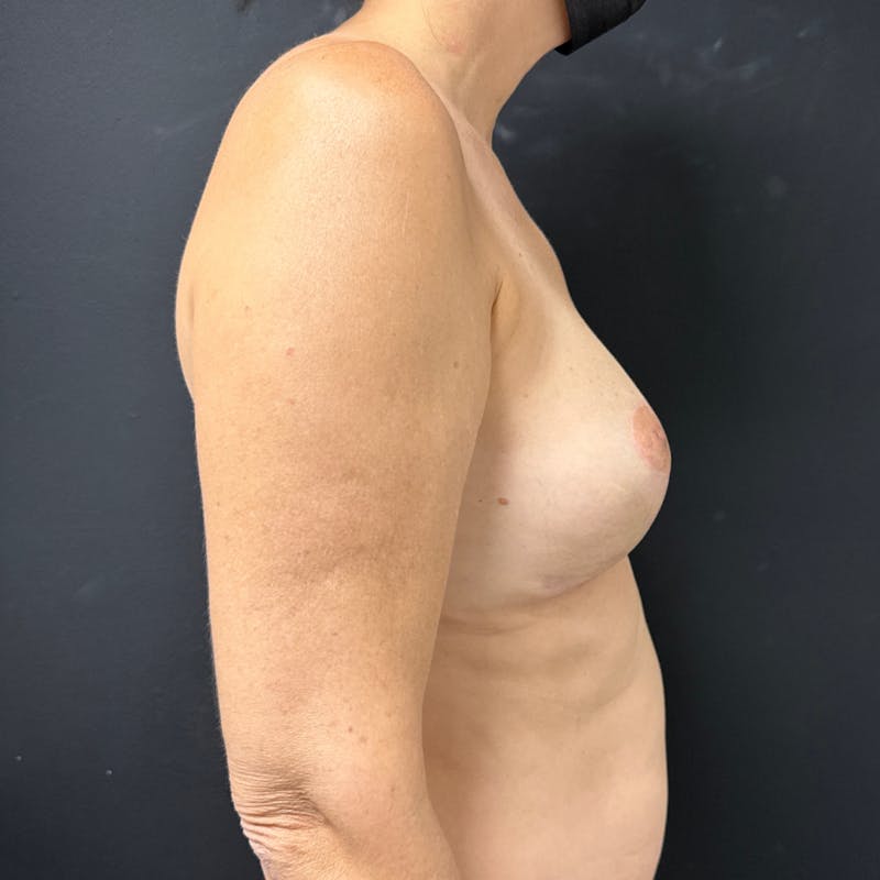 Implant Exchange Before & After Gallery - Patient 429256 - Image 6