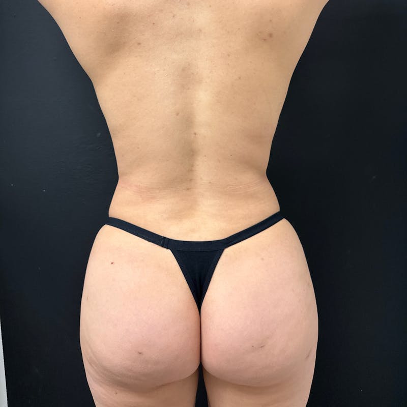 Liposuction Before & After Gallery - Patient 217224 - Image 10