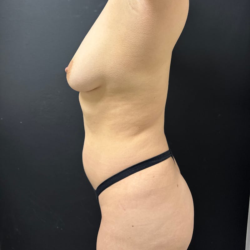 Liposuction Before & After Gallery - Patient 217224 - Image 5