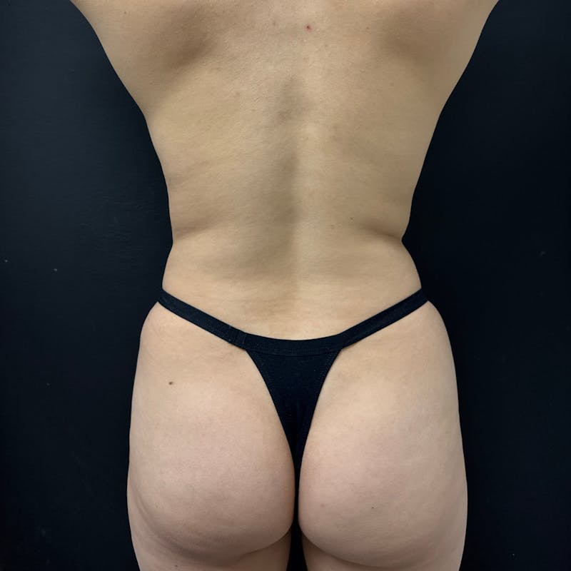 Liposuction Before & After Gallery - Patient 217224 - Image 9