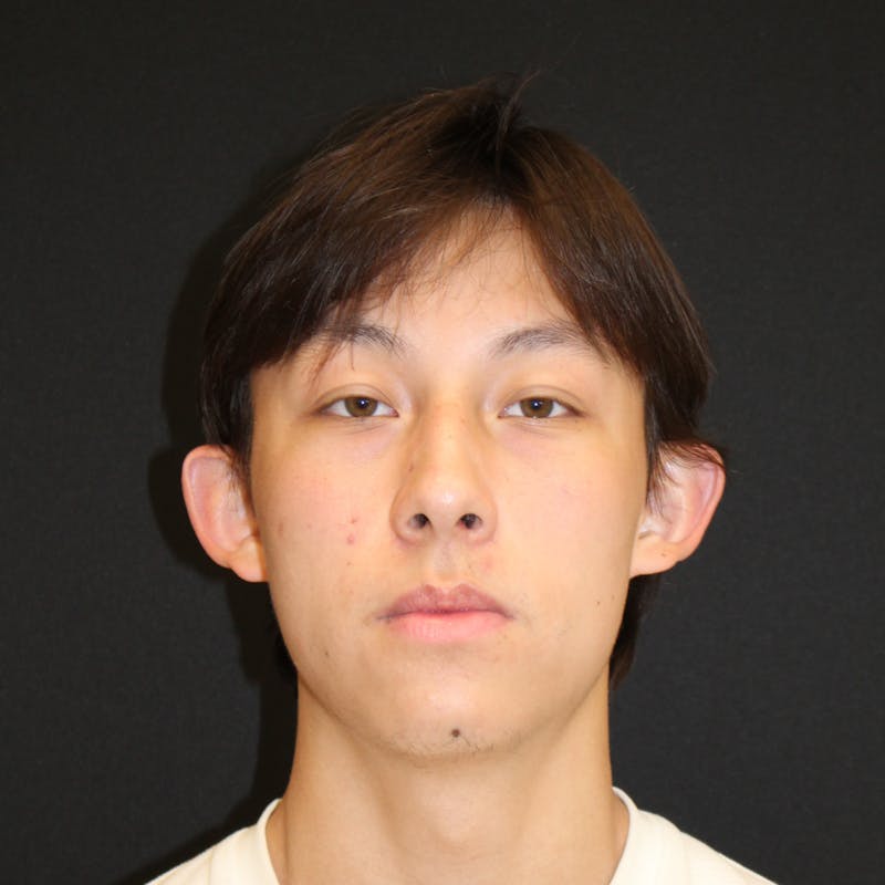 Otoplasty Before & After Gallery - Patient 749293 - Image 1