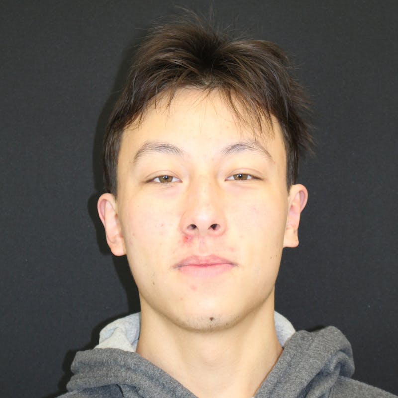 Otoplasty Before & After Gallery - Patient 749293 - Image 2