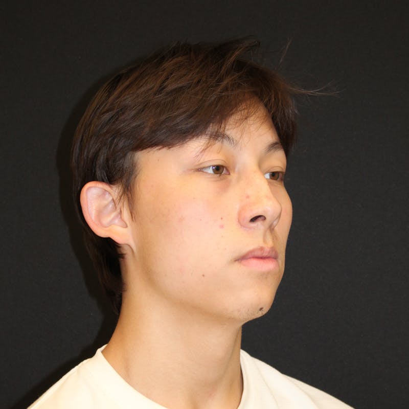 Otoplasty Before & After Gallery - Patient 749293 - Image 3
