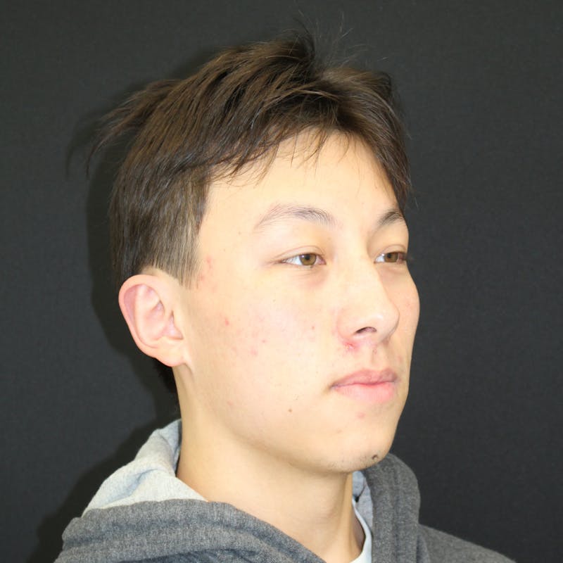 Otoplasty Before & After Gallery - Patient 749293 - Image 4