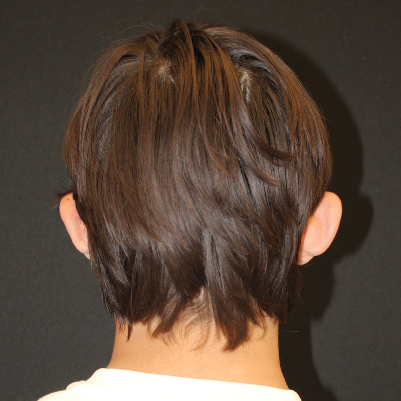 Otoplasty Before & After Gallery - Patient 749293 - Image 5