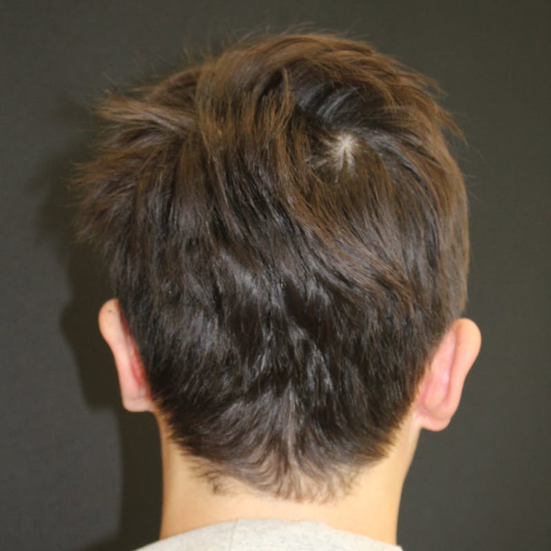 Otoplasty Before & After Gallery - Patient 749293 - Image 6