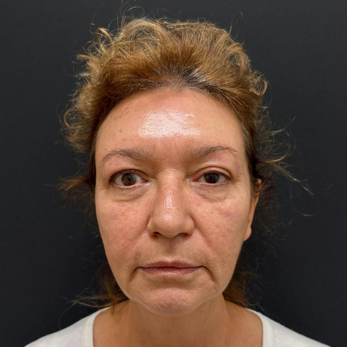 Dermal Fillers Before & After Gallery - Patient 392436 - Image 1
