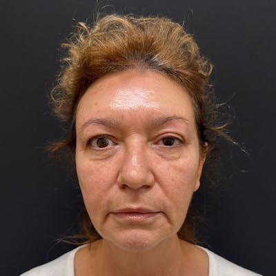 Dermal Fillers Before & After Gallery - Patient 392436 - Image 1